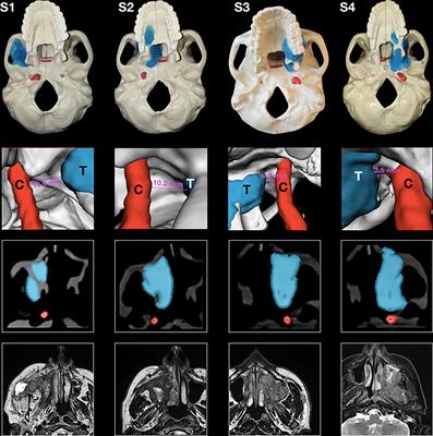 Navigation-Guided Transnasal Endoscopic Delineation of the Posterior Margin for <mark class="highlighted">Maxillary Sinus</mark> Cancers: A Preclinical Study